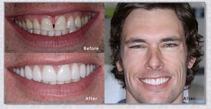 Premium snap-on veneers made with micro-thin polypropylene to instantly transform your smile