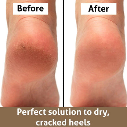 Professional Foot File Rasp for Callus Removal - Durable Stainless Steel Construction with Elegant Golden Finish