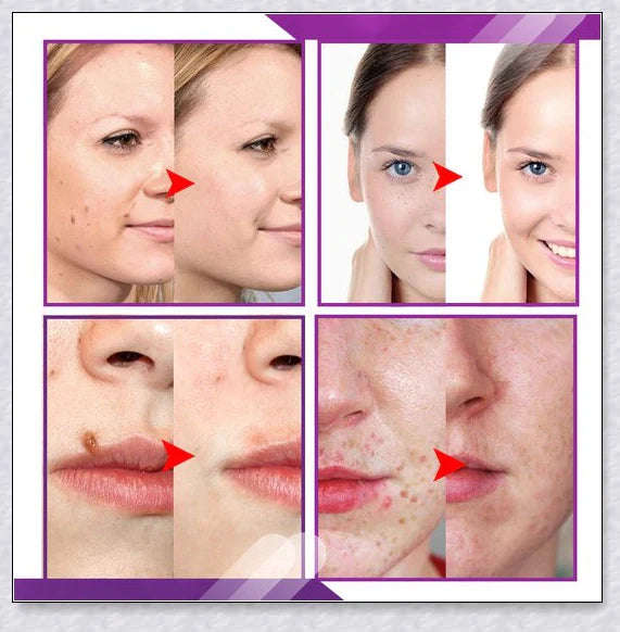 Premium organic skin tag removal serum with natural botanical ingredients for effective, gentle skin rejuvenation